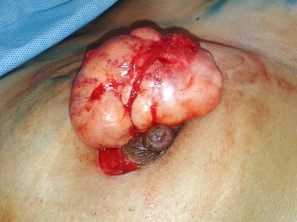 6x7 cm fibroadenoma removed through the incision